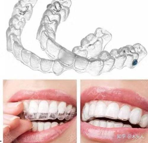 隐形牙套国产经历视频